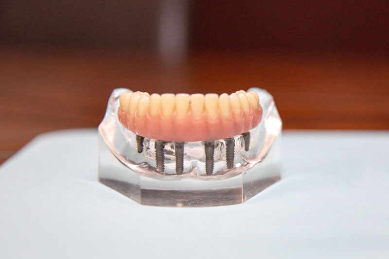 full arch dental implant model