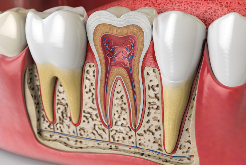 root canal